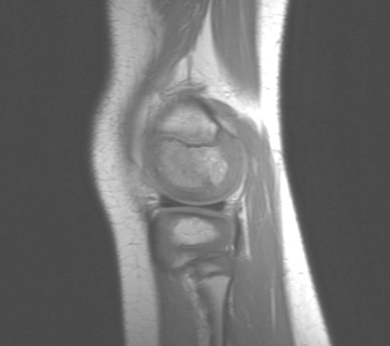 Figure 5 for case Staphylococcus osteomyelitis ( RID3715 )